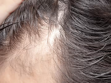 Hair Fall